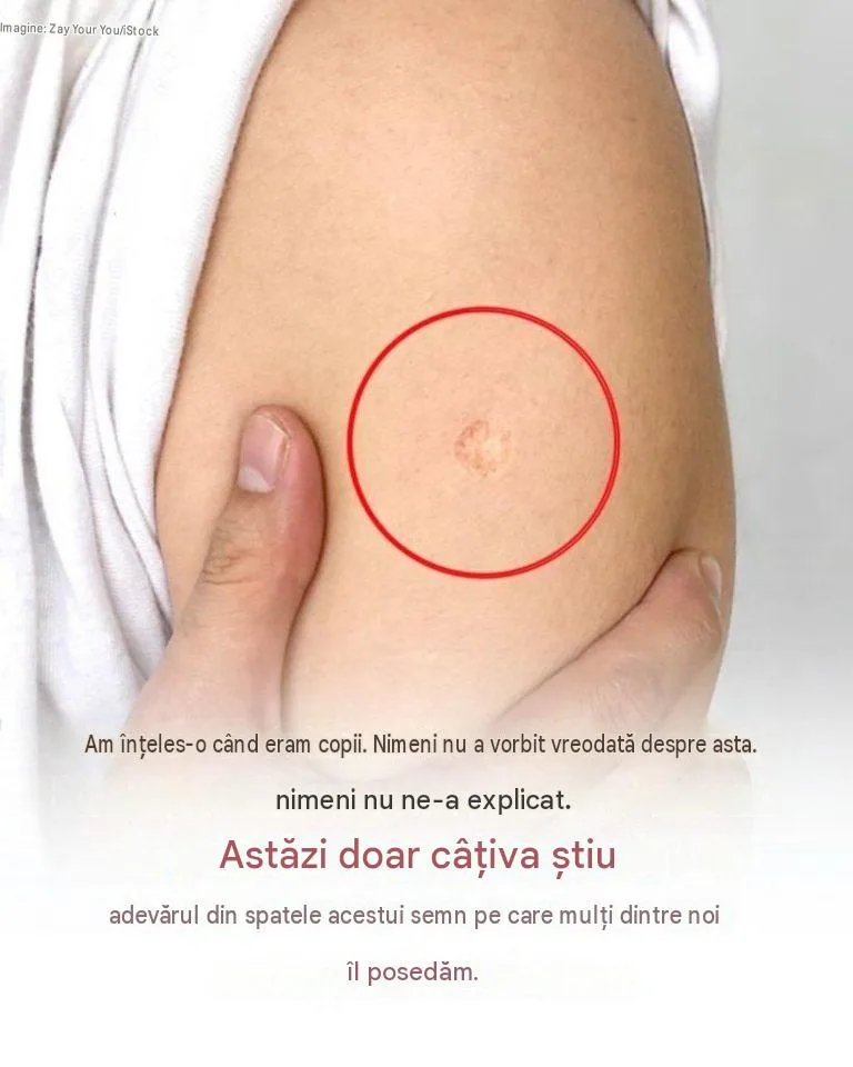 Persoanele care cresc în Asia, Africa, America Latină sau în unele părți ale Europei de Est sunt mai predispuse să aibă o cicatrice mică, rotundă, pe braț. Are dimensiunea unei radiere, ușor adâncită și probabil puțin mai deschisă decât pielea din jur.