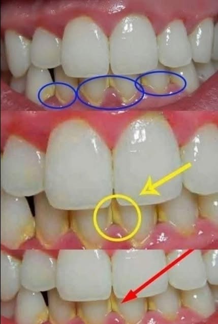 Îndepărtează placa dentară în 5 minute în mod natural, fără a merge la dentist.