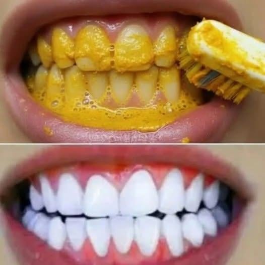 Zâmbet strălucitor: Albirea naturală a dinților cu turmeric