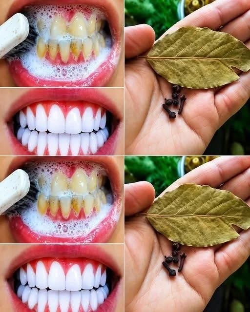 Albește-ți dinții în mod natural cu cuișoare și frunze de dafin în 2 minute