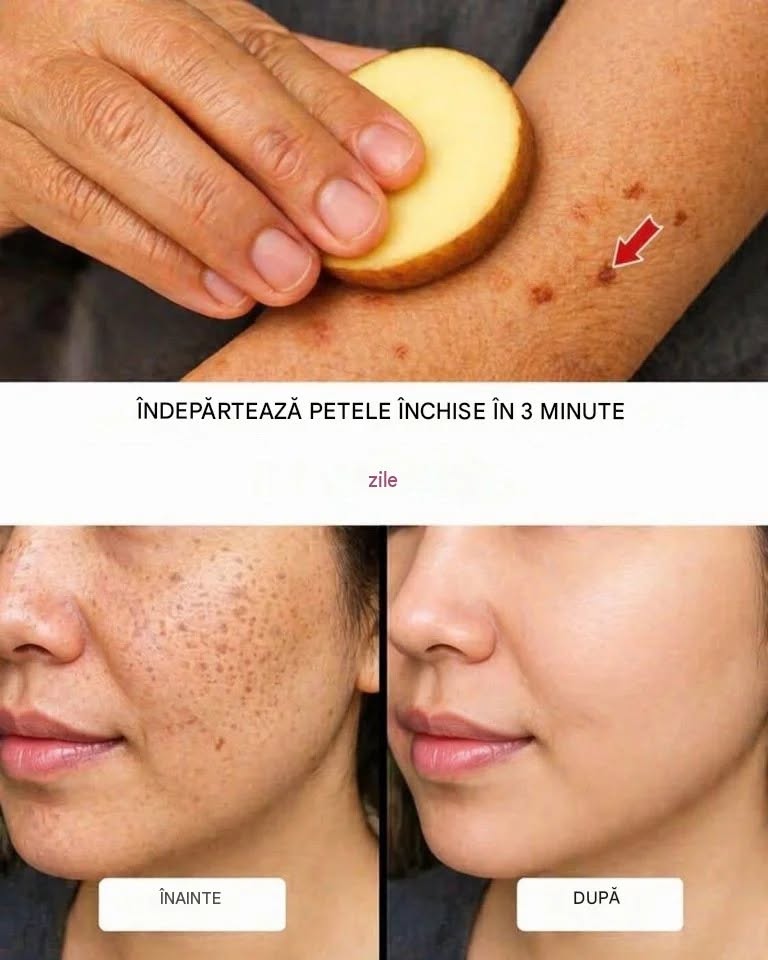 Îndepărtează petele de vârstă, melasma, petele solare, imperfecțiunile pielii și semnele îmbătrânirii.